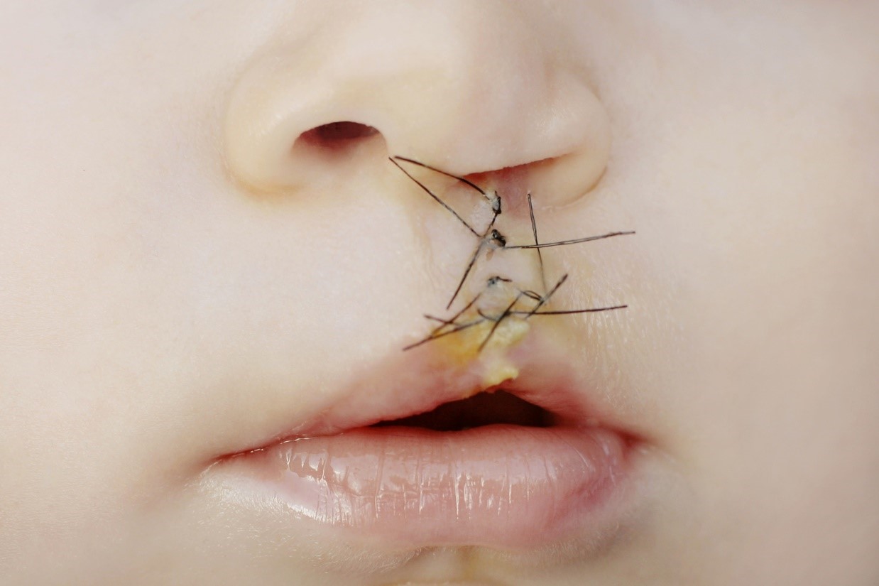 Translational use of Wharton’s jelly In repairing cleft lip and palate