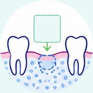 In-situ barrier for minor guided bone regeneration procedures