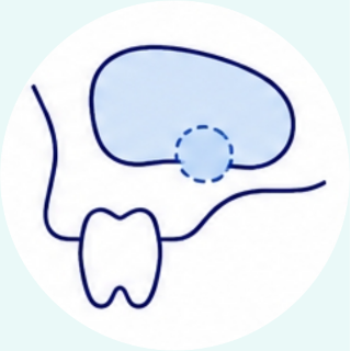 Maxillary Antrum Schneiderian membrane perforation repair