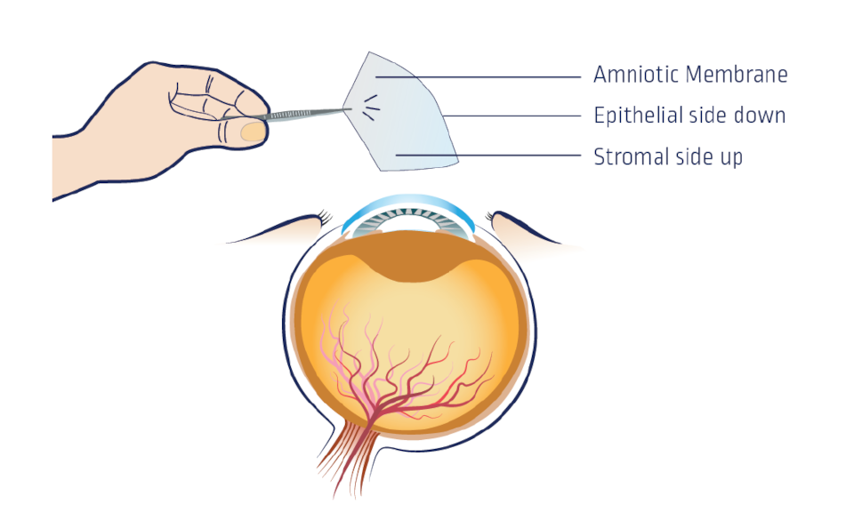 Dehydrated AmnioMatrix