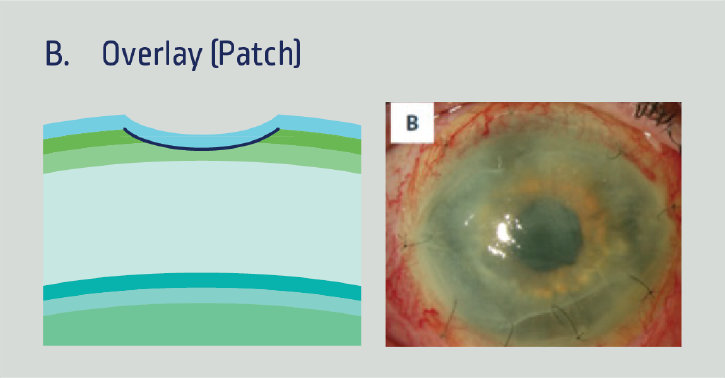 Overlay (Patch) Technique