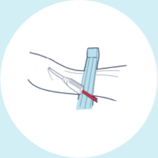 A sterile needle is inserted into the umbilical cord vein and the blood is collected into a sterile medical bag.